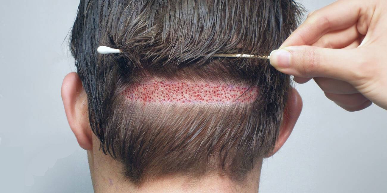 FUT Hair Transplant in Pakistan